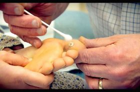 Cryotherapy For Plantar Warts | Leading Health Podiatry Cryotherapy For Plantar Warts | Leading Health Podiatry